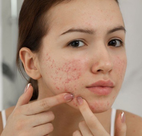 Acne Treatment at Garg dental & Aesthetic Clinic Gorakhpur