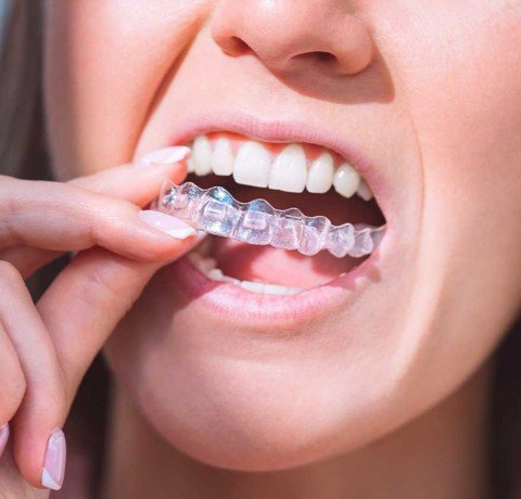 Braces & Invisalign at Garg dental & Aesthetic Clinic Gorakhpur
