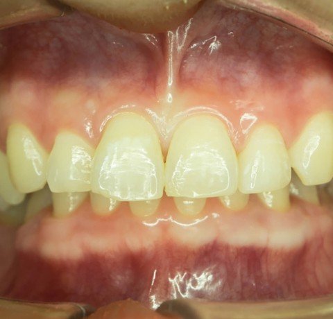 De-Pigmentation of Gums at Garg dental & Aesthetic Clinic Gorakhpur