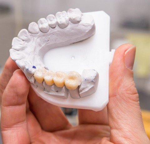 Dental Bridge at Garg dental & Aesthetic Clinic Gorakhpur