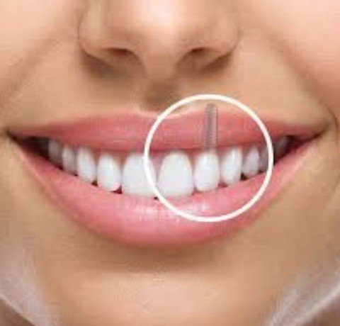 Dental Implants at Garg dental & Aesthetic Clinic Gorakhpur