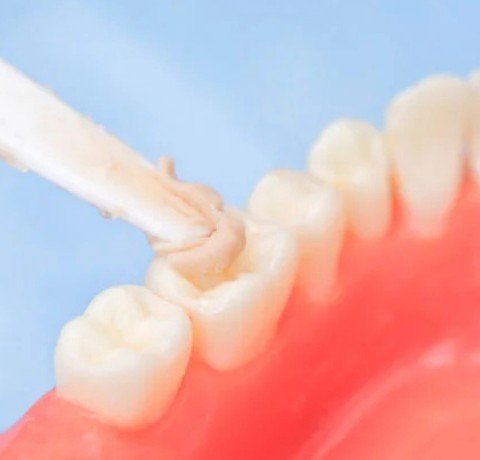 Fillings (Composite & GIC) at Garg dental & Aesthetic Clinic Gorakhpur