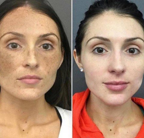 Melasma Treatment at Garg dental & Aesthetic Clinic Gorakhpur