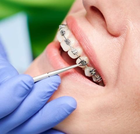 Orthodontic Treatment at Garg dental & Aesthetic Clinic Gorakhpur