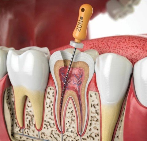 Root Canal Treatment at Garg dental & Aesthetic Clinic Gorakhpur (1)