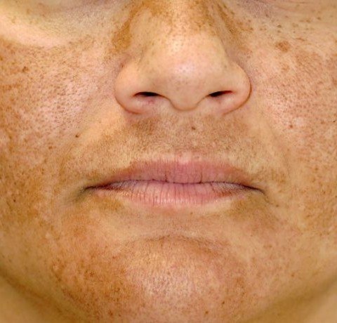 Skin Pigmentation Treatment at Garg dental & Aesthetic Clinic Gorakhpur
