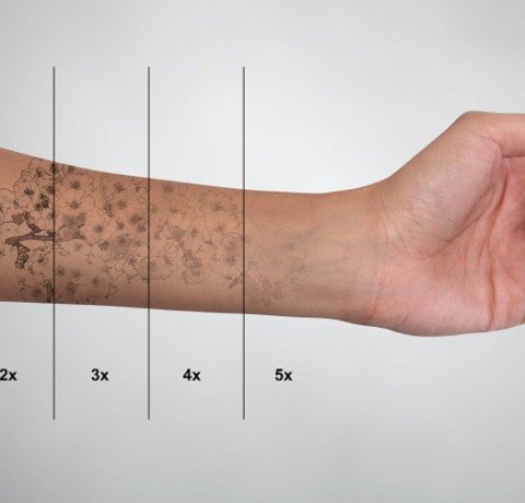 Tattoo Removal at Garg dental & Aesthetic Clinic Gorakhpur