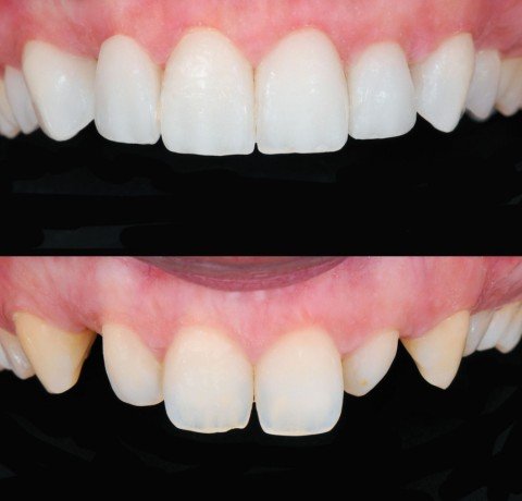Teeth Bonding at Garg dental & Aesthetic Clinic Gorakhpur