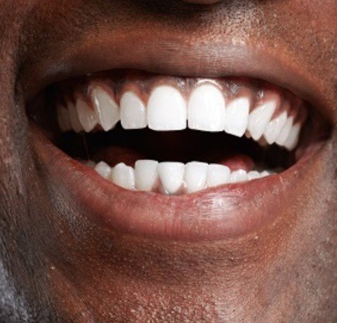 Teeth Whitening at Garg dental & Aesthetic Clinic Gorakhpur