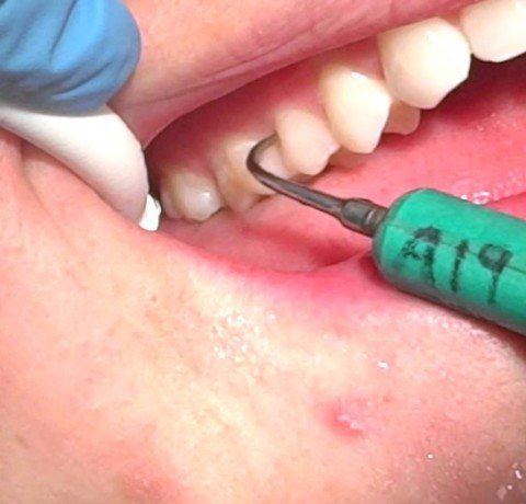 Ultrasonic Teeth Cleaning at Garg dental & Aesthetic Clinic Gorakhpur