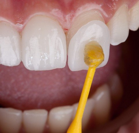 Veneers at Garg dental & Aesthetic Clinic Gorakhpur